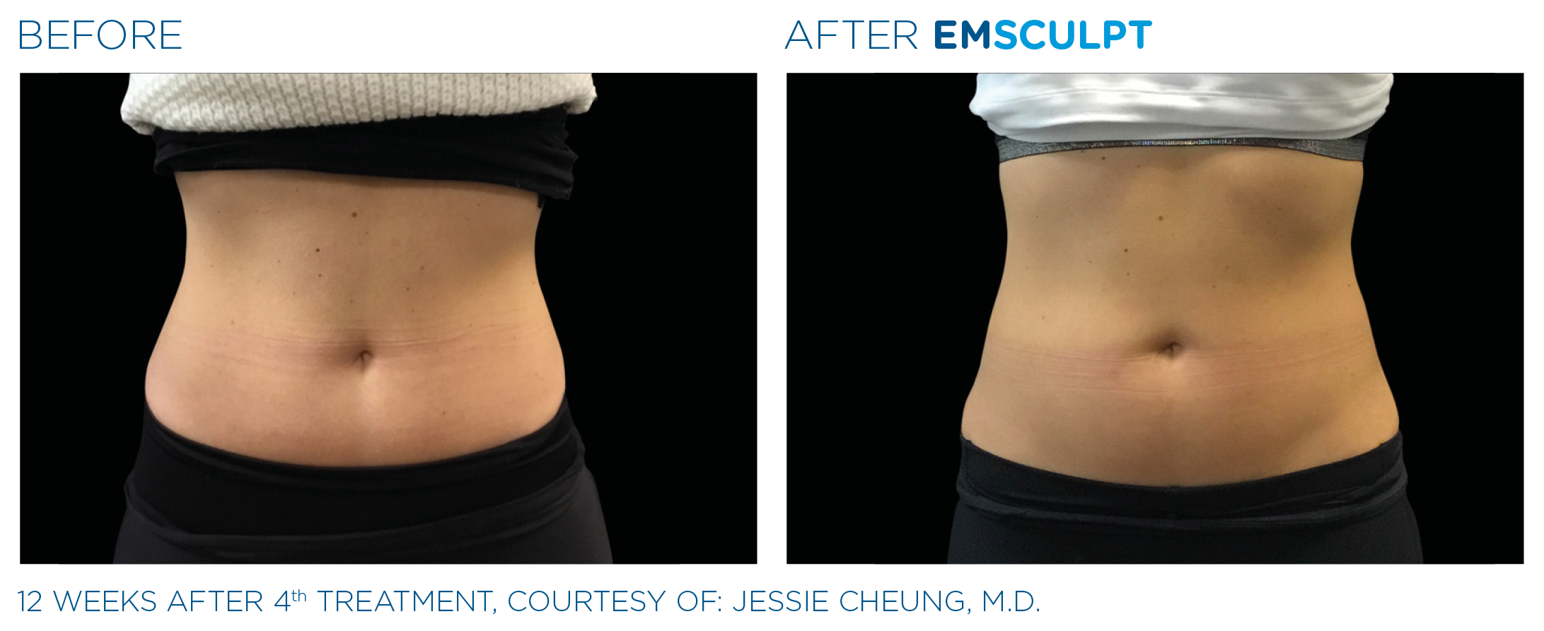 Emsculpt before and after