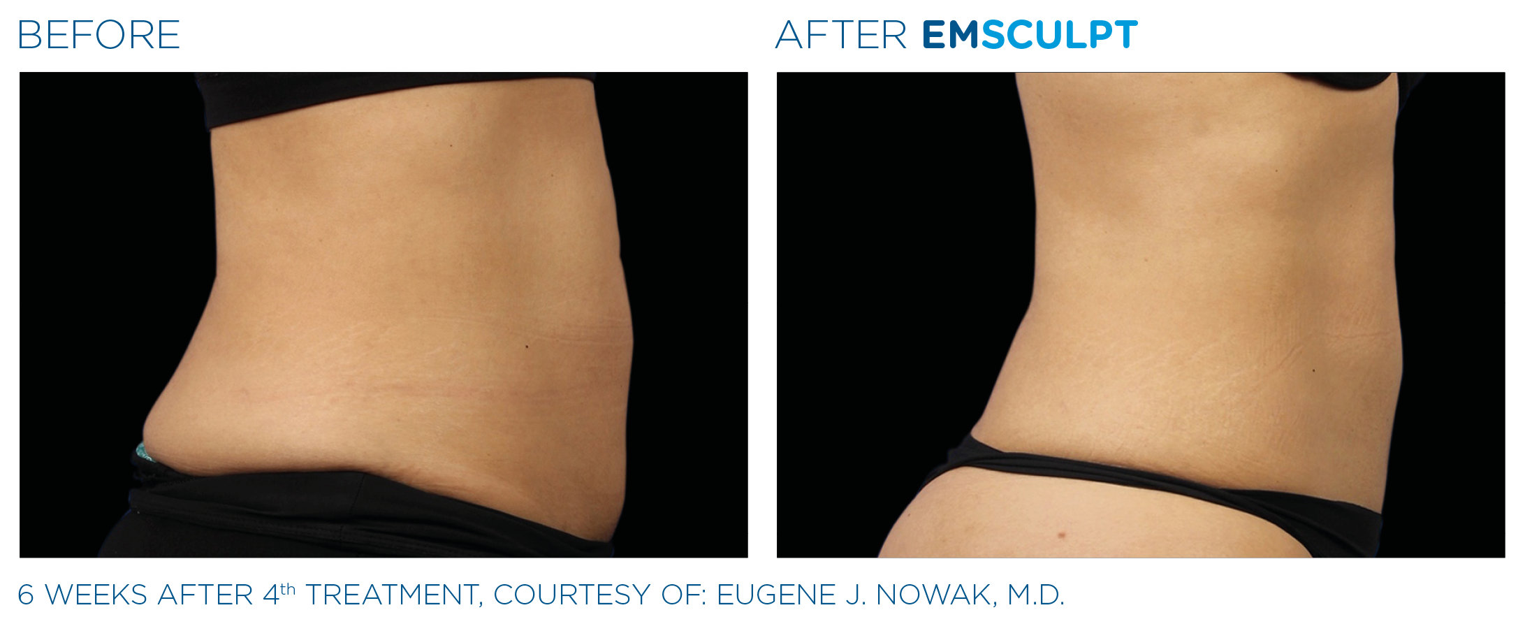 Emsculpt before and after