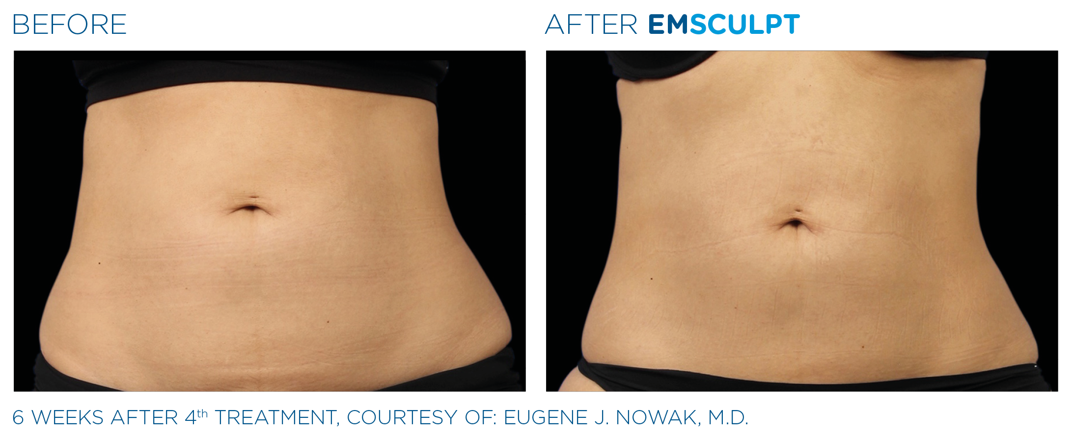 Emsculpt before and after