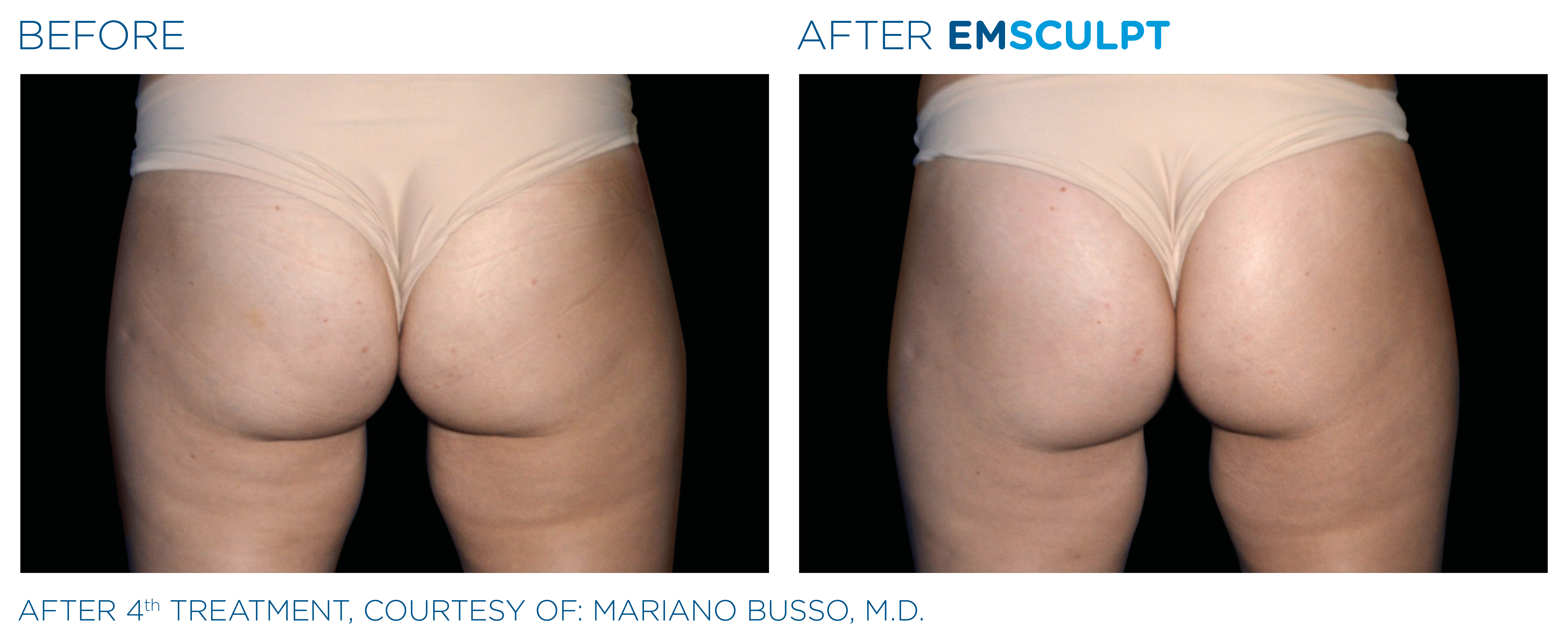 Emsculpt before and after