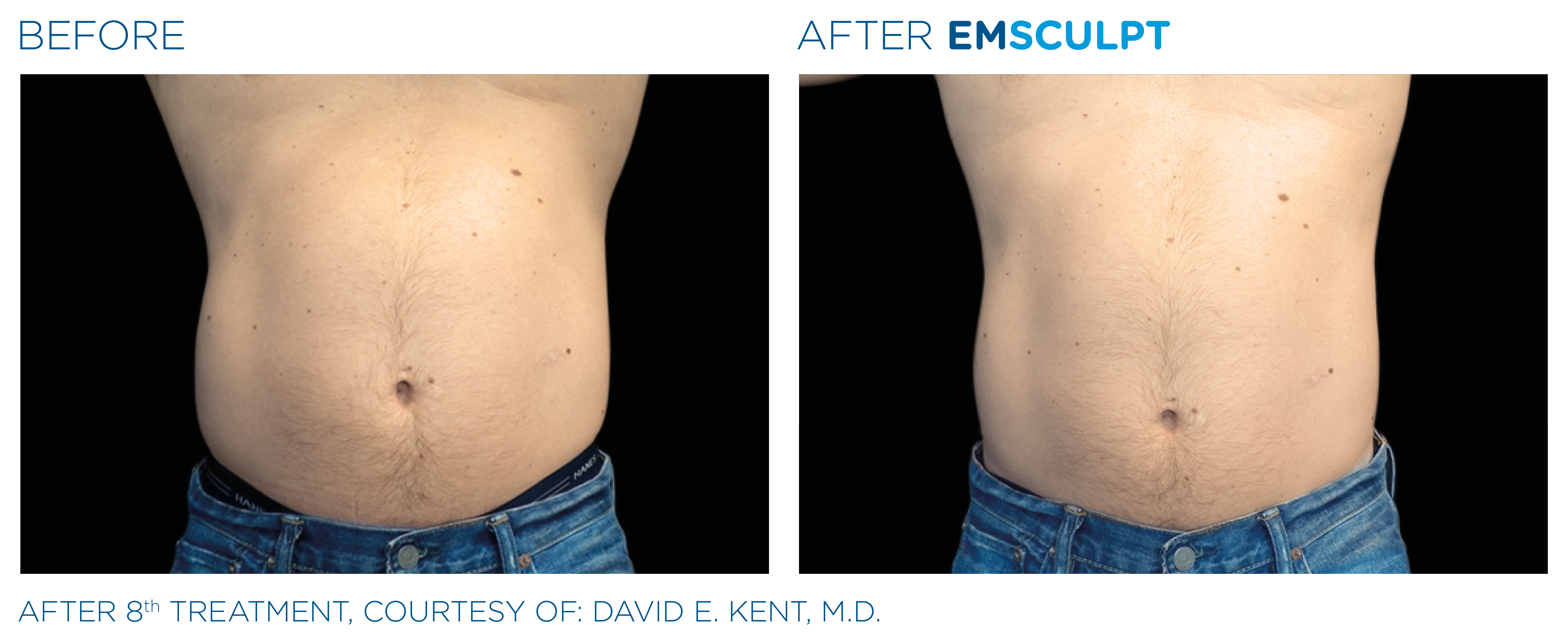 Emsculpt before and after