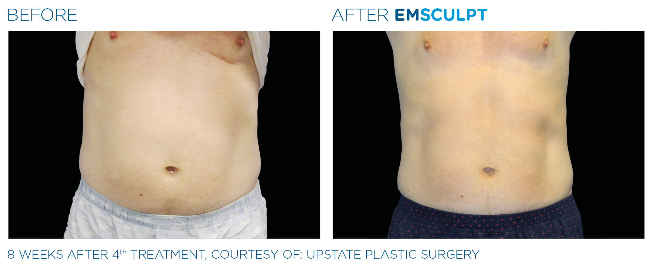 Emsculpt before and after