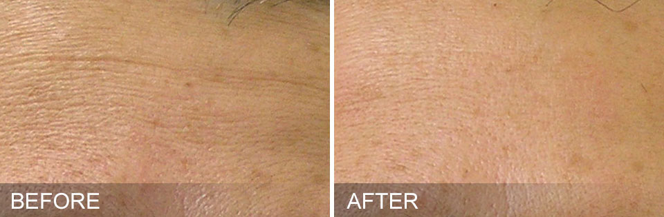 Before & after of a Hydrafacial treatment