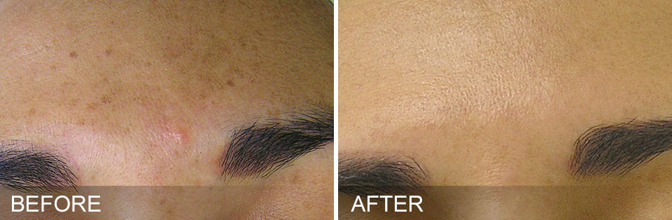 Before & after of a woman who received hydrafacial treatment