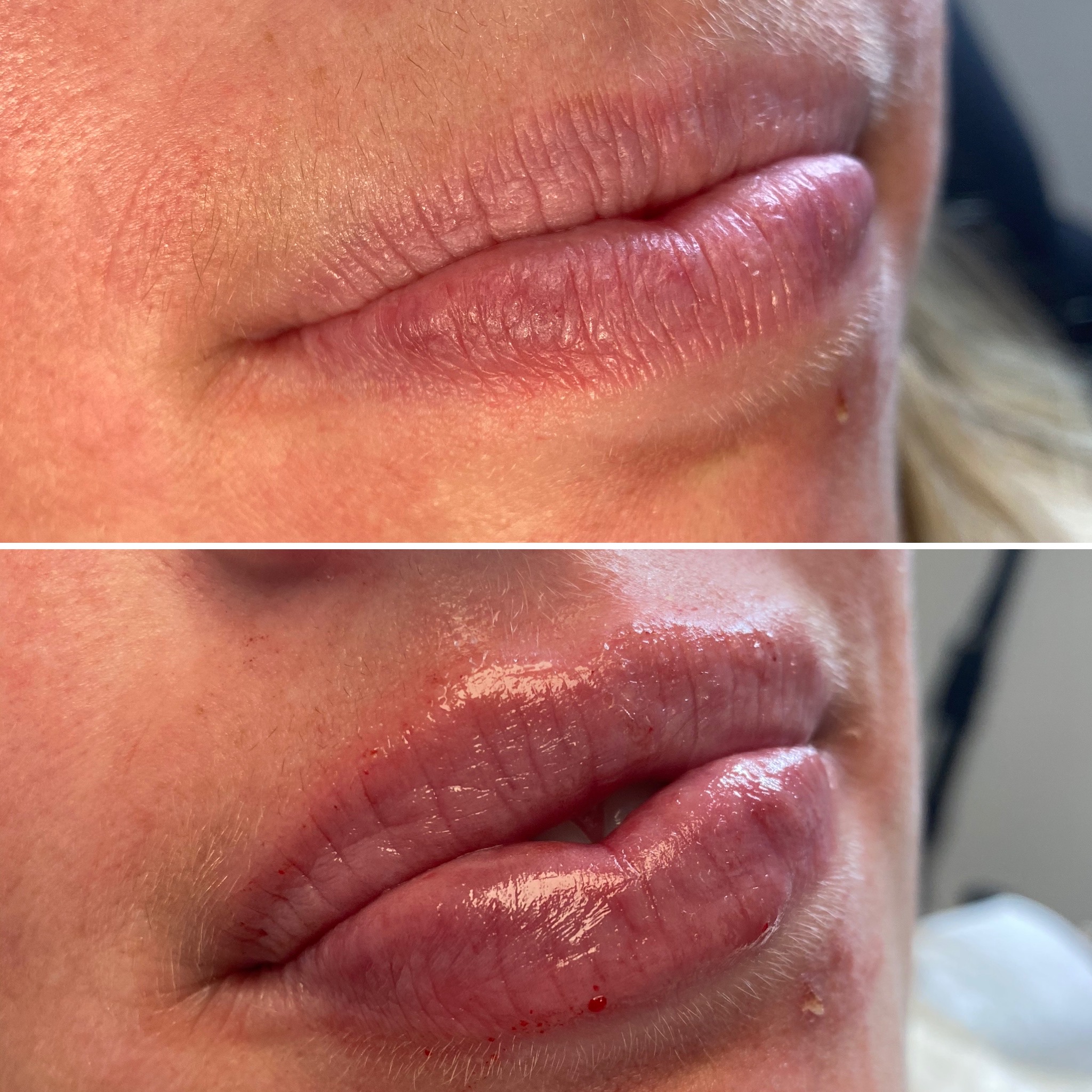 What Not to Do After a Lip Filler Injection?