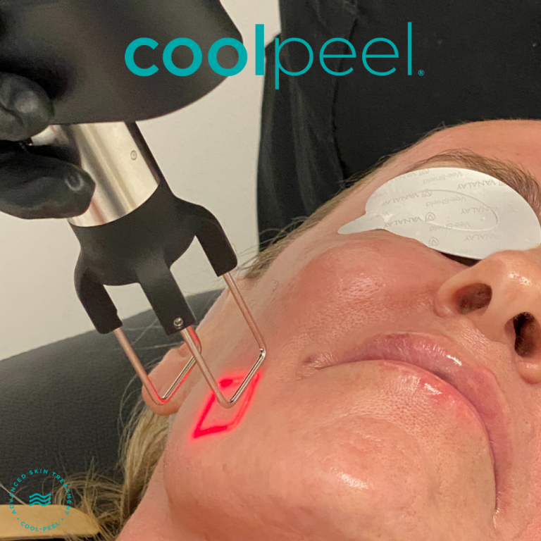 Woman getting CoolPeel treatment at The Shot Shop
