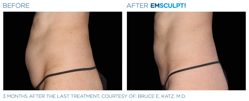 Before & After of a woman who got Emsculpt Neo treatment