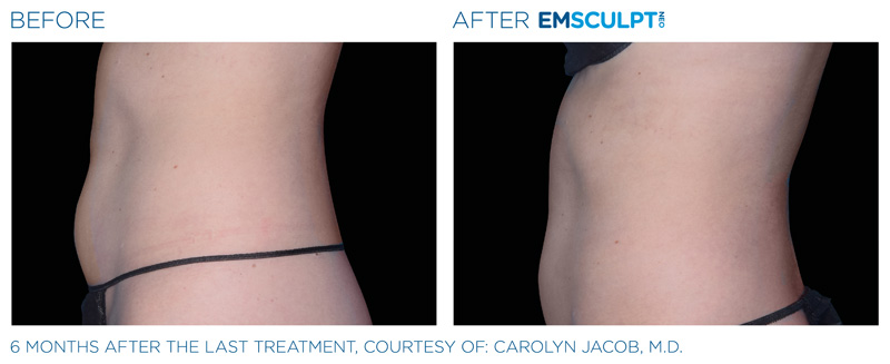 Before & After of a woman's side profile after getting Emsculpt Neo treatment