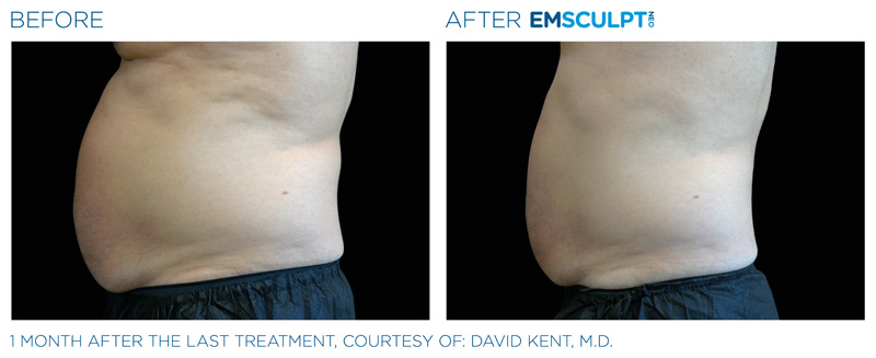 Before & After of a man's side profile after getting Emsculpt Neo treatment