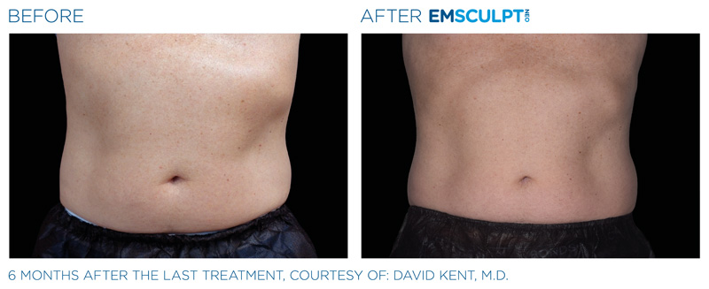 Before & After of a man's stomach after getting Emsculpt Neo treatment