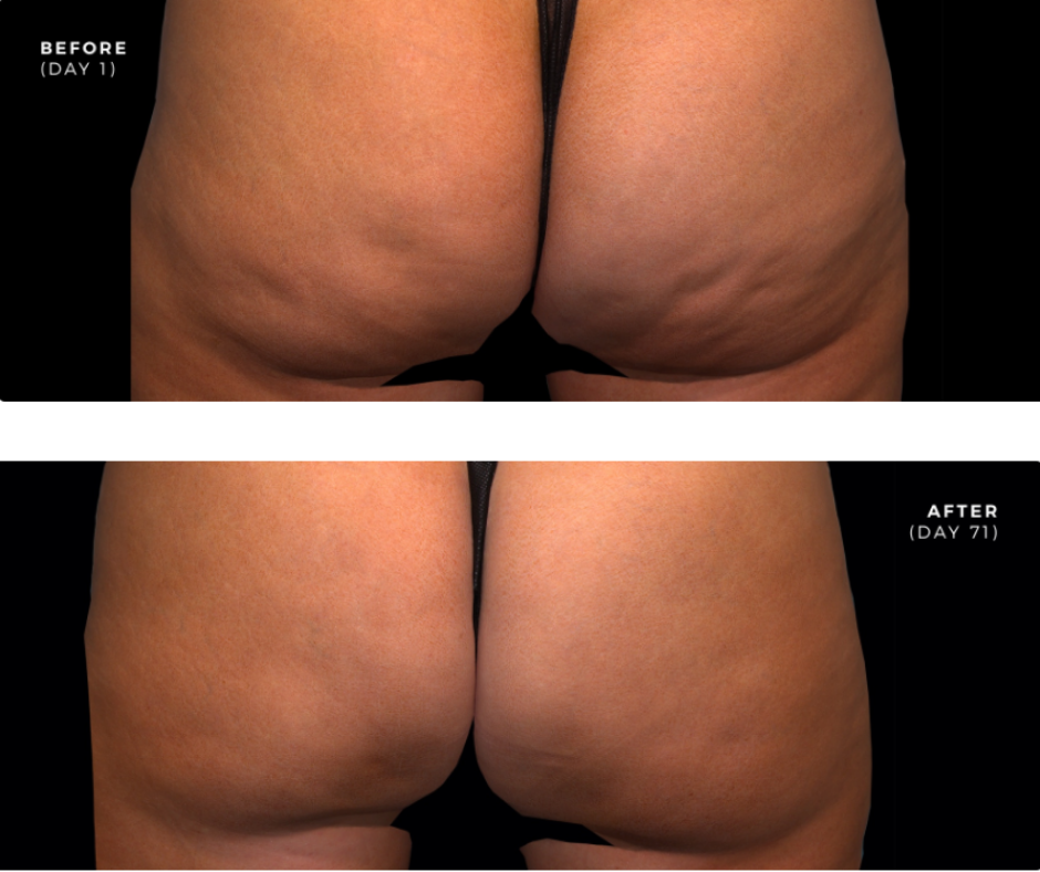 Before & After of a woman's buttocks after getting QWO Cellulite treatment