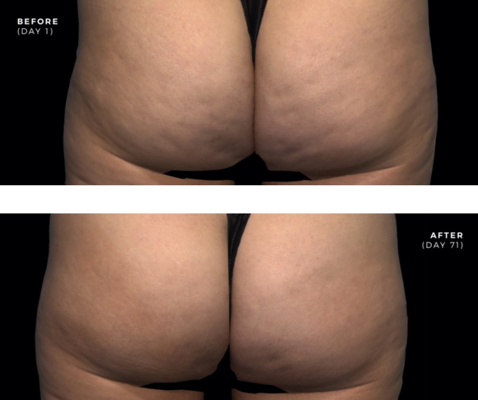 Before & After of a woman's butt after getting QWO Cellulite treatment