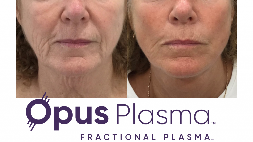 Opus Plasma Skin Resurfacing Shot Shop Med Spa