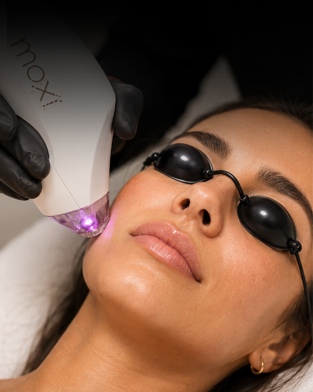 MOXI laser treatment at The Shot Shop