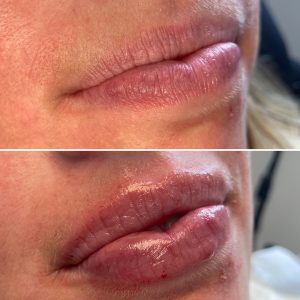 Before & After picture of a woman who got Lip Filler treatment